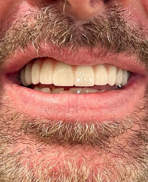 After smile transformation 1