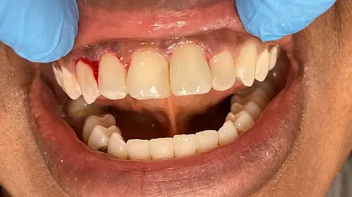 After smile transformation 11