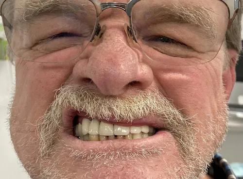 After smile transformation 12