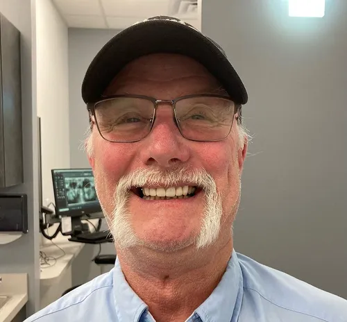 After smile transformation 13 alternate view