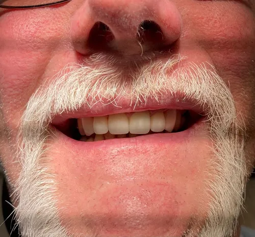 After smile transformation 13