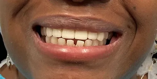 After smile transformation 14