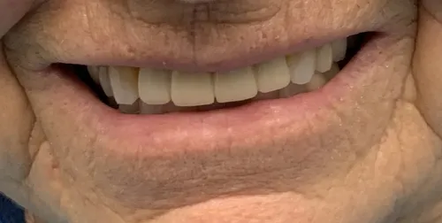 After smile transformation 15