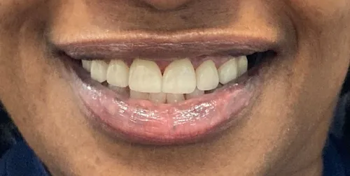 After smile transformation 17