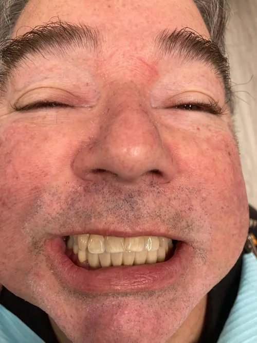 After smile transformation 18