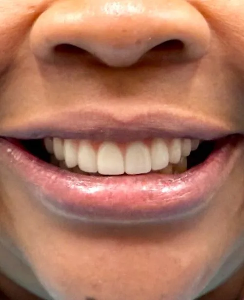 After smile transformation 2