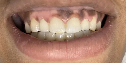 After smile transformation 20