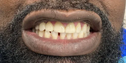 After smile transformation 22