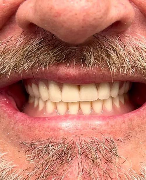 After smile transformation 3