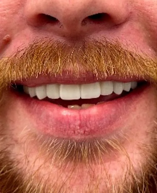 After smile transformation 4