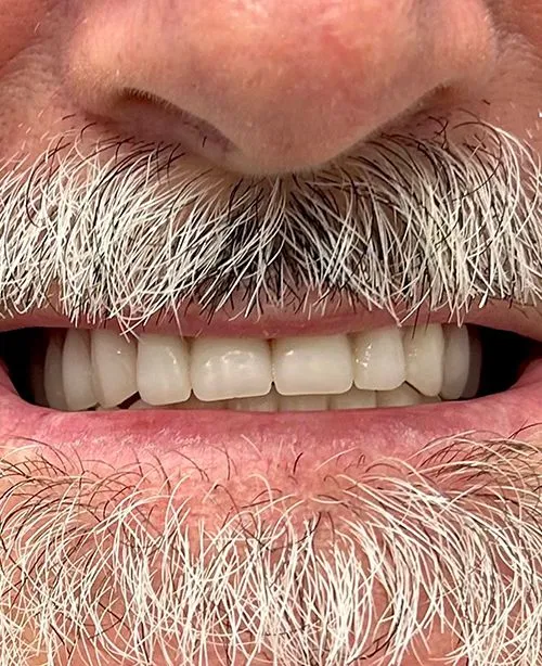 After smile transformation 5