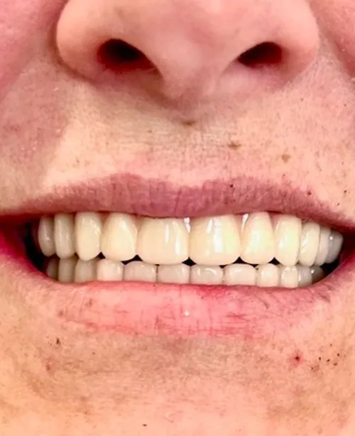 After smile transformation 6