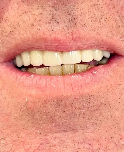 After smile transformation 7