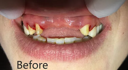 Before smile transformation 8