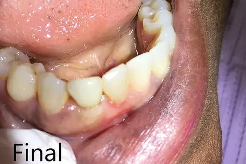 After smile transformation 9