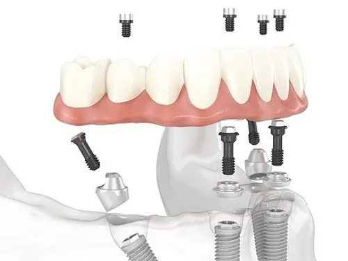 All-On-X implants at [practice_name]