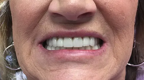 After smile transformation 10