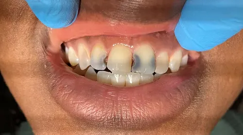 Before smile transformation 11