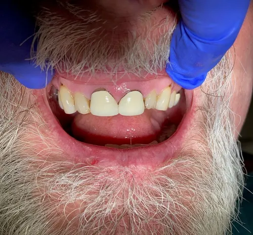 Before smile transformation 13