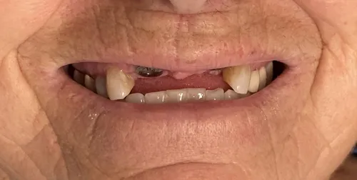 Before smile transformation 15