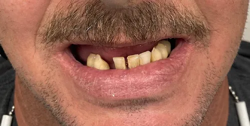 Before smile transformation 16