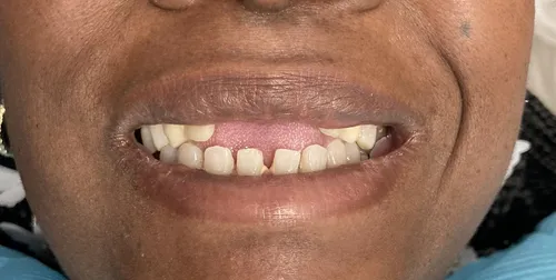 Before smile transformation 19