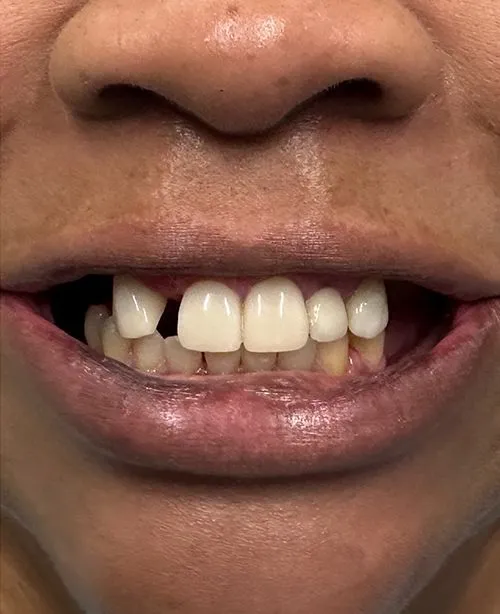 Before smile transformation 2