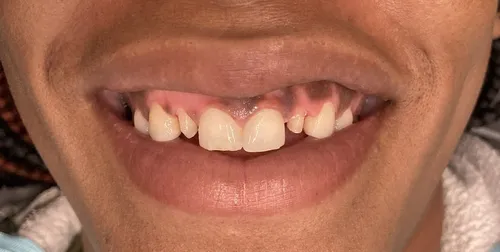 Before smile transformation 20