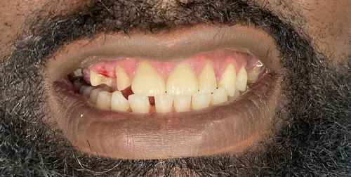 Before smile transformation 22