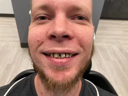 Before smile transformation 23