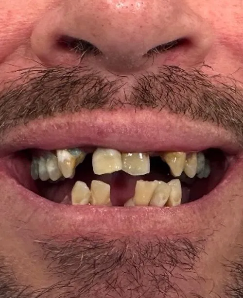 Before smile transformation 3