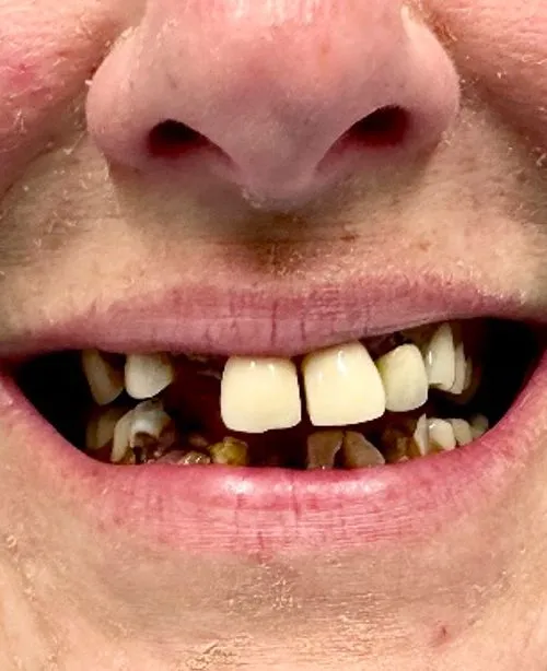 Before smile transformation 6