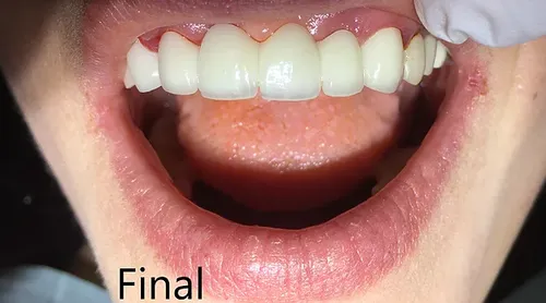 After smile transformation 8