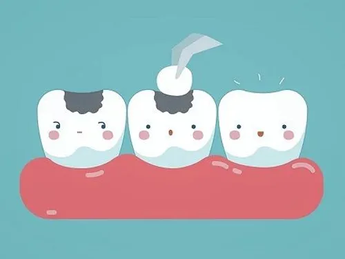 Composite dental fillings at [practice_name]