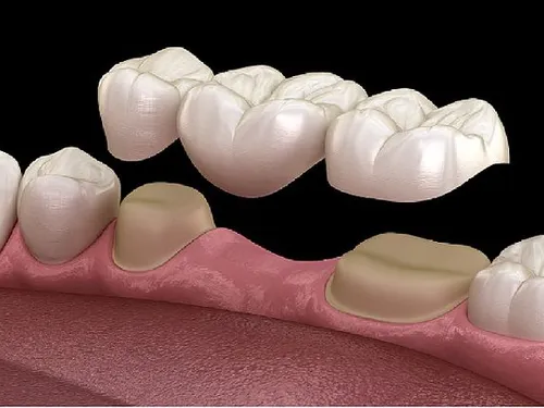 Dental bridge at [practice_name]