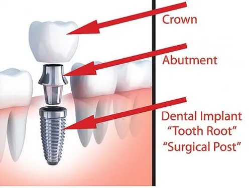 Dental implants at [practice_name]