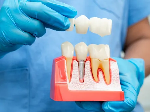 Single tooth dental implant