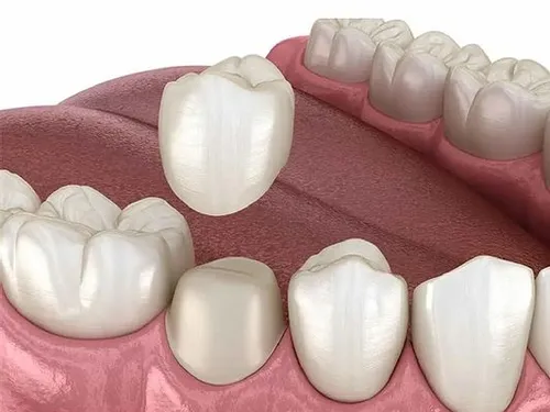 Dental crown restoration at [practice_name]