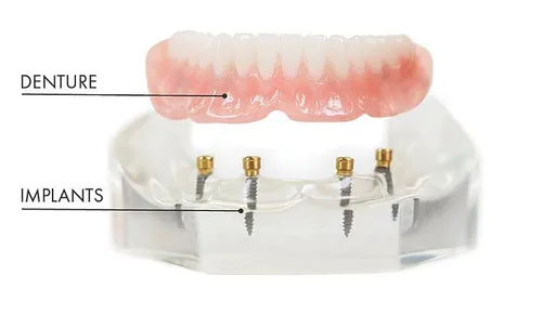 Implant-supported dentures at [practice_name]