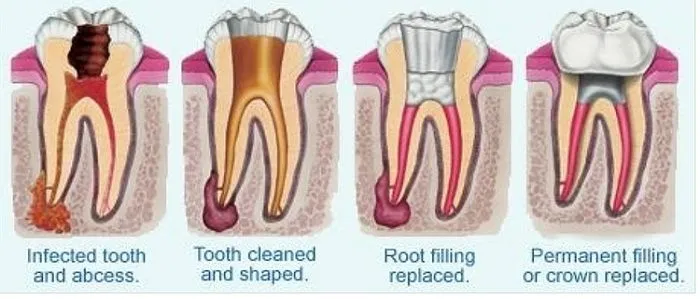 Root canal therapy at [practice_name]