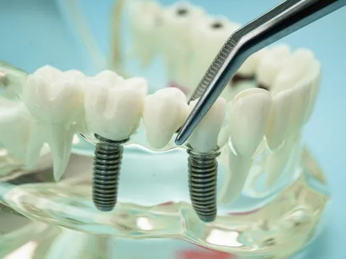 Benefits of Teeth-in-a-Day