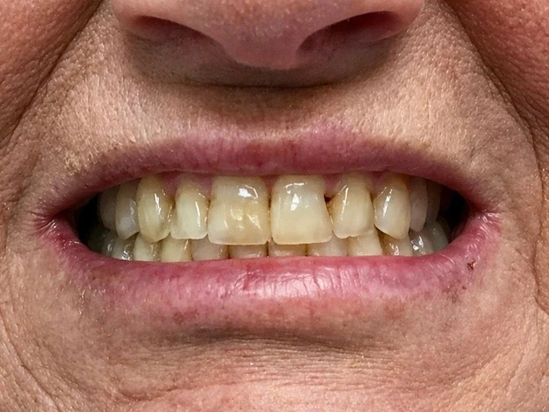 Before: Smile transformation 10