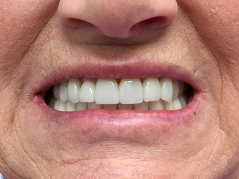 After: Smile transformation 10