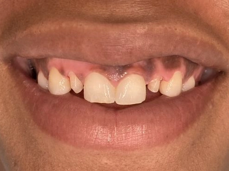 Before: Smile transformation 15
