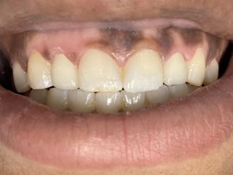 After: Smile transformation 15