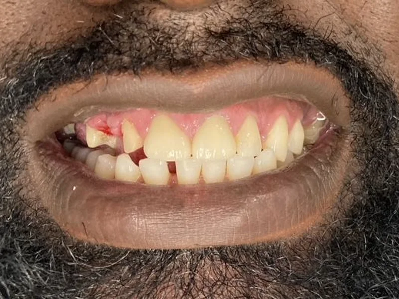 Before: Smile transformation 16