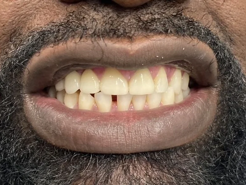 After: Smile transformation 16