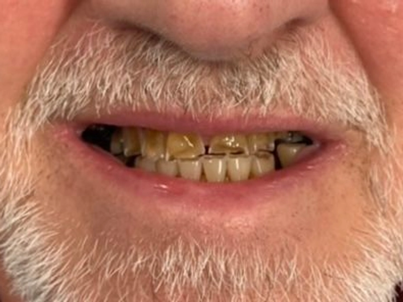 Before: Smile transformation 17