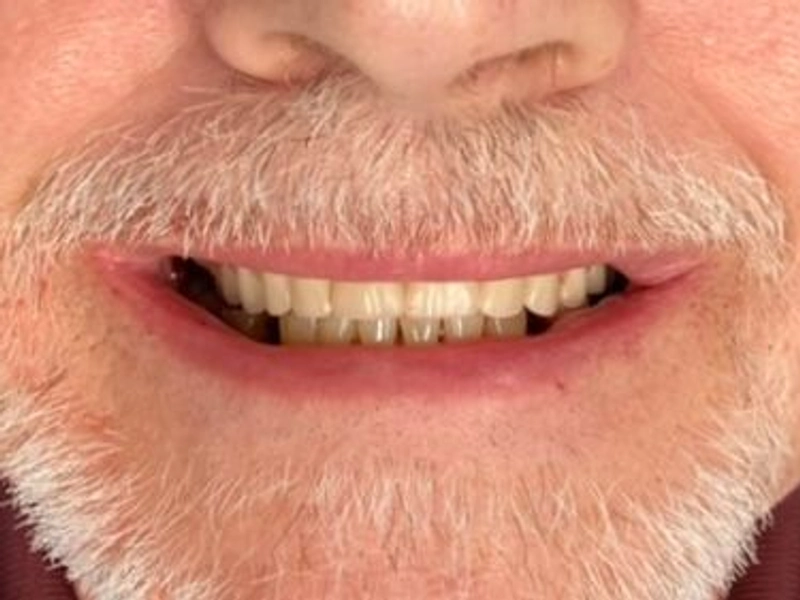 After: Smile transformation 17