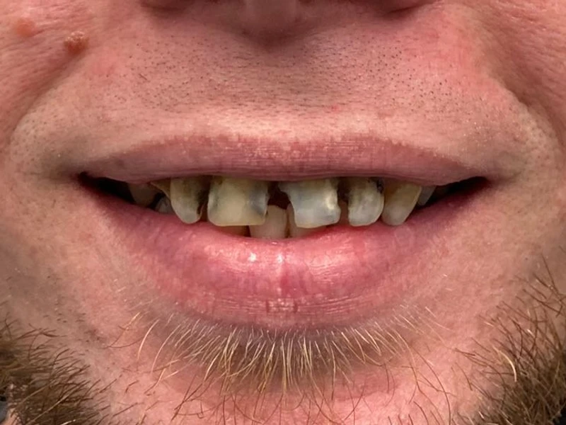 Before: Smile transformation 18